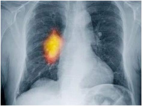 Vắcxin điều trị ung thư phổi đầu tiên trên thế giới 